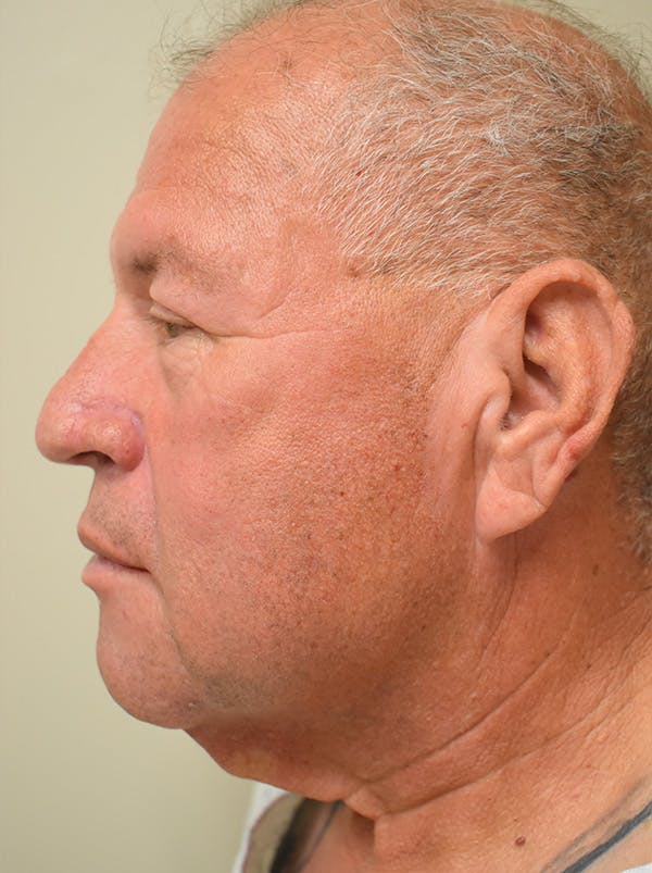 Neck Lift Before & After Gallery - Patient 281766 - Image 5