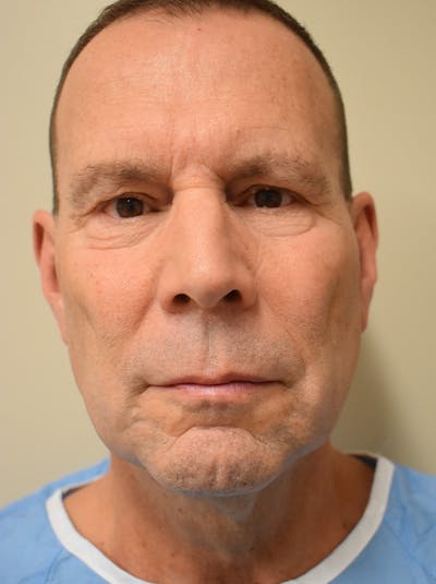 Facelift Before & After Gallery - Patient 309421 - Image 1