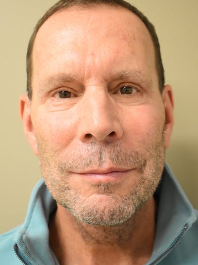 Eyelid Surgery Before & After Gallery - Patient 422991 - Image 2