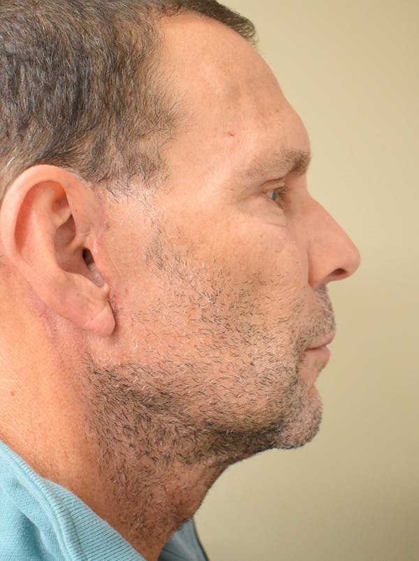 Eyelid Surgery Before & After Gallery - Patient 422991 - Image 4