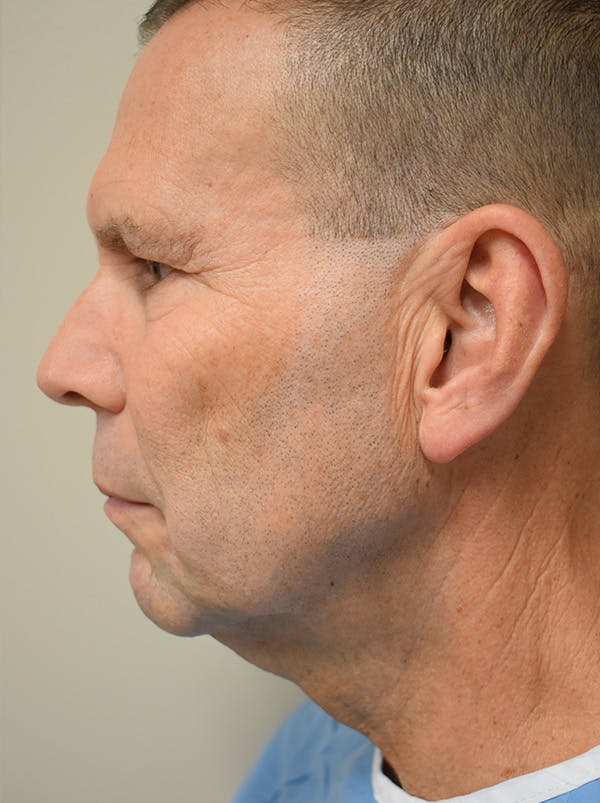 Eyelid Surgery Before & After Gallery - Patient 422991 - Image 5