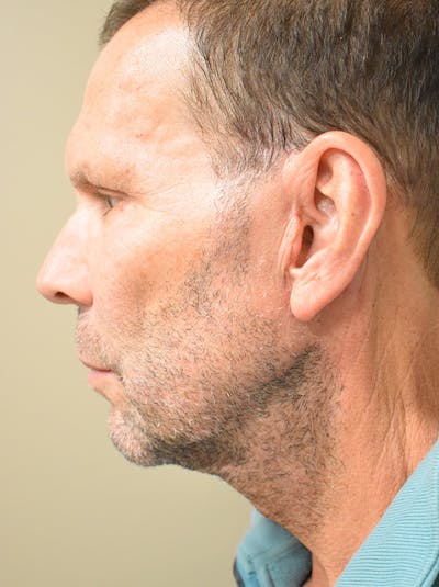 Eyelid Surgery Before & After Gallery - Patient 422991 - Image 6