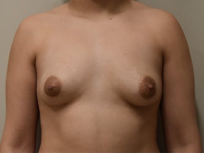 Breast Augmentation Before & After Gallery - Patient 720556 - Image 1