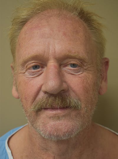 Co2 Laser Resurfacing Before & After Gallery - Patient 655743 - Image 1