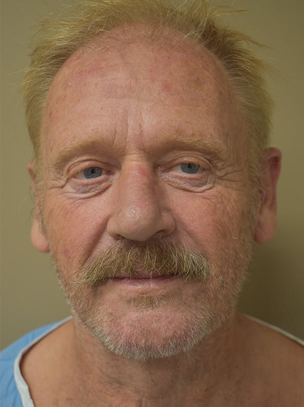Facelift Before & After Gallery - Patient 746793 - Image 1