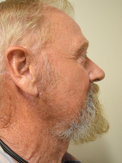 Facelift Before & After Gallery - Patient 746793 - Image 4