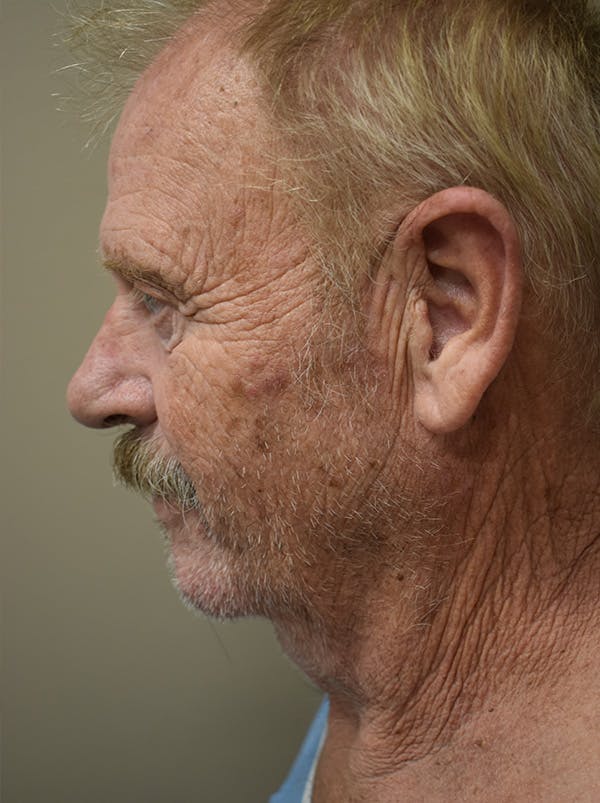 Facelift Before & After Gallery - Patient 746793 - Image 5