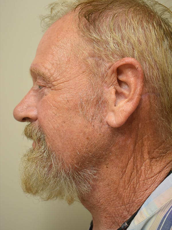 Facelift Before & After Gallery - Patient 746793 - Image 6