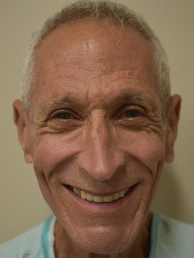 Nasolabial Fold Before & After Gallery - Patient 734117 - Image 1
