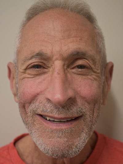 Nasolabial Fold Before & After Gallery - Patient 734117 - Image 2