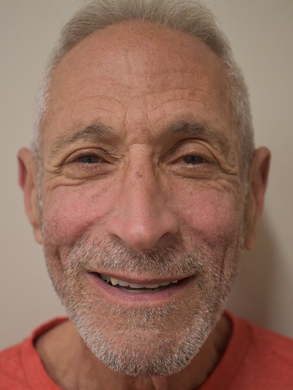 Nasolabial Fold Before & After Gallery - Patient 734117 - Image 2