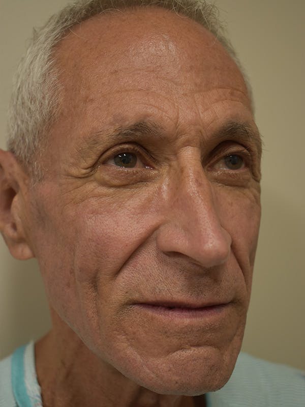 Nasolabial Fold Before & After Gallery - Patient 734117 - Image 3