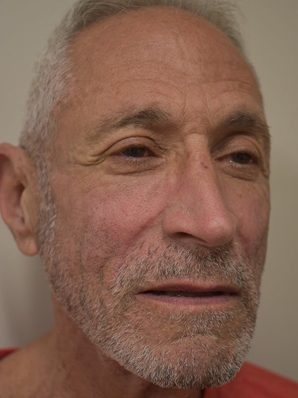 Nasolabial Fold Before & After Gallery - Patient 734117 - Image 4
