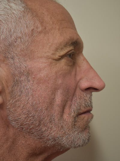 Nasolabial Fold Before & After Gallery - Patient 734117 - Image 6