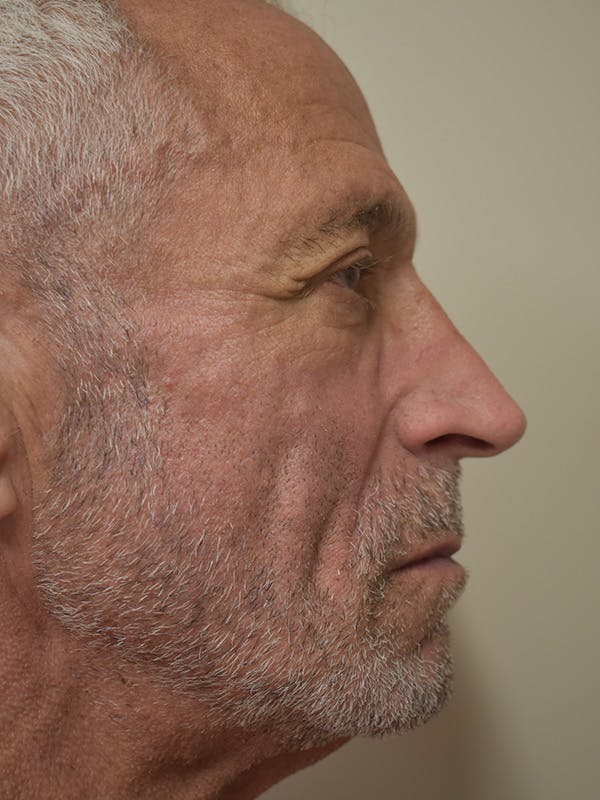 Nasolabial Fold Before & After Gallery - Patient 734117 - Image 6