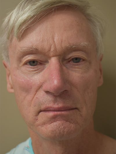 Co2 Laser Resurfacing Before & After Gallery - Patient 896616 - Image 1