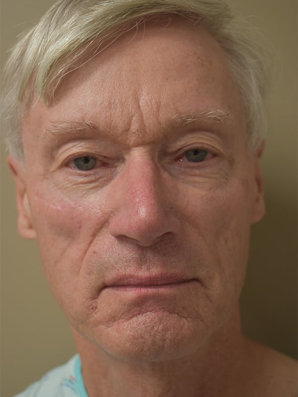 Co2 Laser Resurfacing Before & After Gallery - Patient 896616 - Image 1