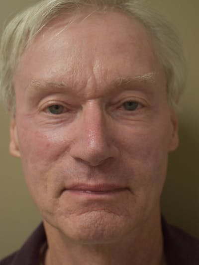 Co2 Laser Resurfacing Before & After Gallery - Patient 896616 - Image 2