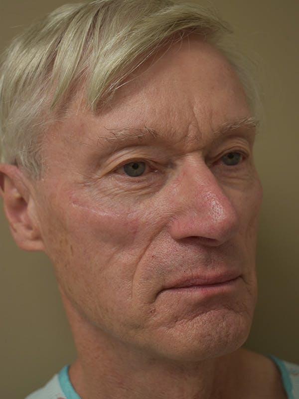 Co2 Laser Resurfacing Before & After Gallery - Patient 896616 - Image 3