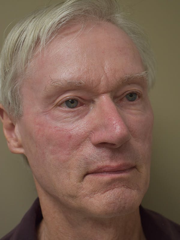 Co2 Laser Resurfacing Before & After Gallery - Patient 896616 - Image 4