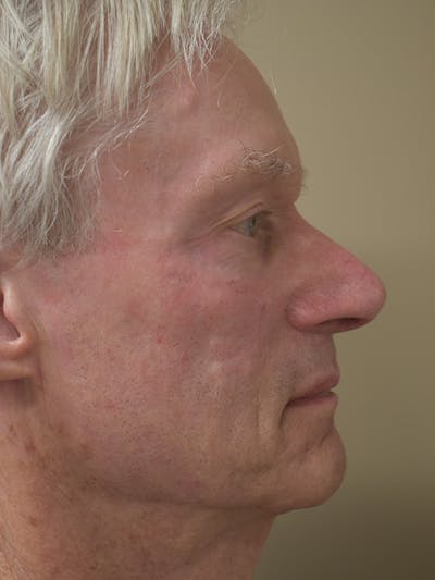Co2 Laser Resurfacing Before & After Gallery - Patient 896616 - Image 6