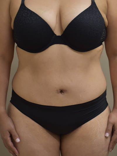 Tummy Tuck Before & After Gallery - Patient 313263 - Image 1