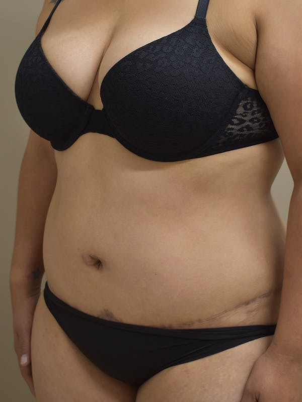Tummy Tuck Before & After Gallery - Patient 313263 - Image 3
