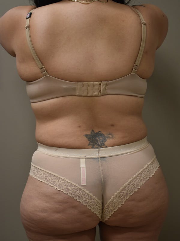Tummy Tuck Before & After Gallery - Patient 313263 - Image 6