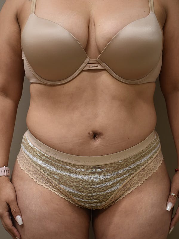 Tummy Tuck Before & After Gallery - Patient 313263 - Image 2