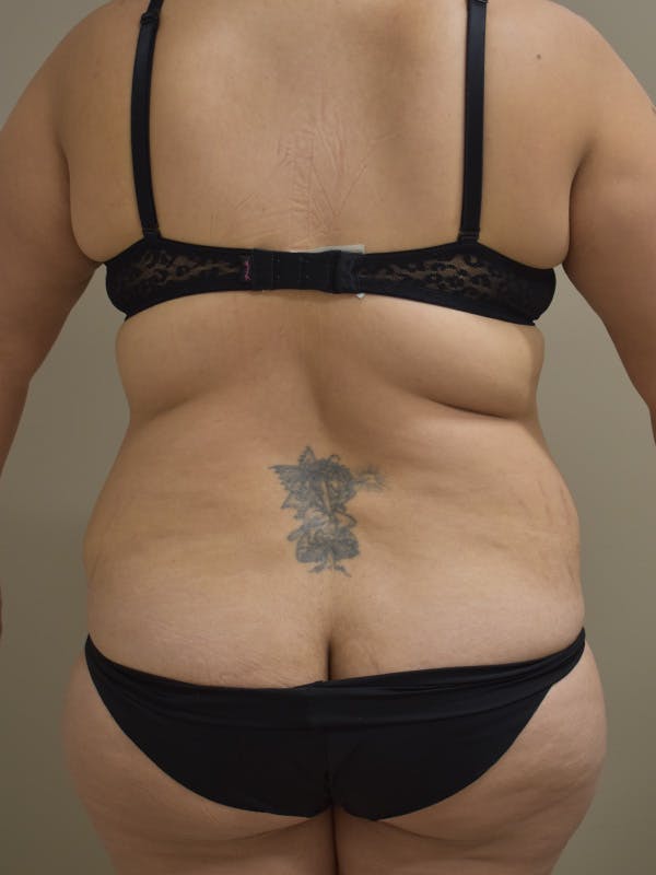 Tummy Tuck Before & After Gallery - Patient 313263 - Image 5