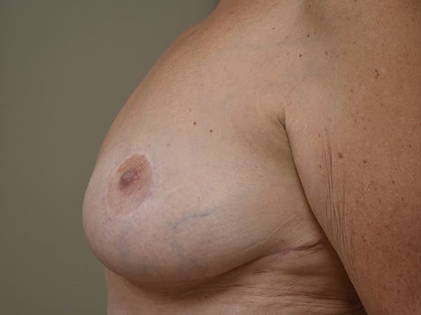 Breast Lift Before & After Gallery - Patient 610618 - Image 6