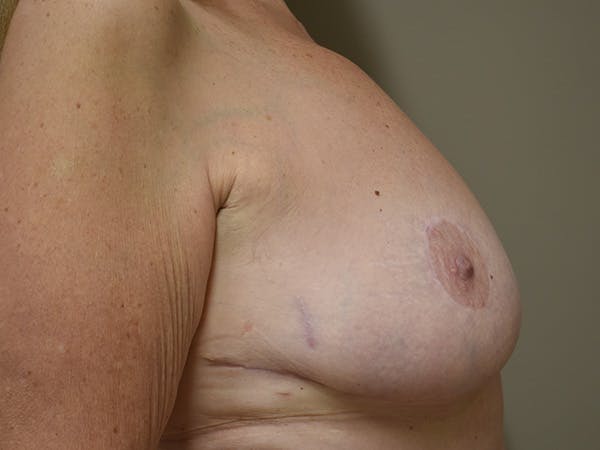 Breast Lift Before & After Gallery - Patient 610618 - Image 4