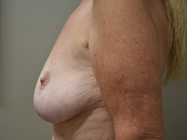 Breast Lift Before & After Gallery - Patient 610618 - Image 5