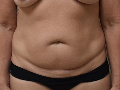 Tummy Tuck Before & After Gallery - Patient 326198 - Image 1