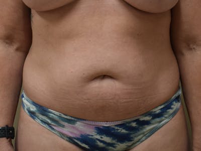 Tummy Tuck Before & After Gallery - Patient 326198 - Image 2