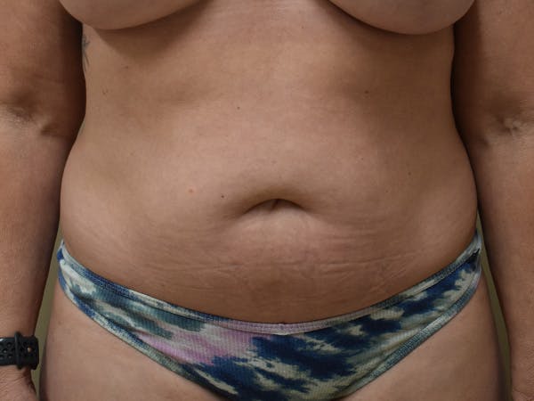 Tummy Tuck Before & After Gallery - Patient 326198 - Image 2