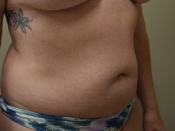 Tummy Tuck Before & After Gallery - Patient 326198 - Image 4