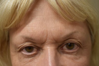 Brow Lift Before & After Gallery - Patient 413329 - Image 1