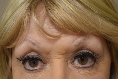 Brow Lift Before & After Gallery - Patient 413329 - Image 2