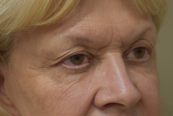 Brow Lift Before & After Gallery - Patient 413329 - Image 3