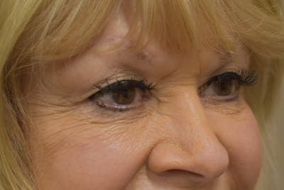 Brow Lift Before & After Gallery - Patient 413329 - Image 4