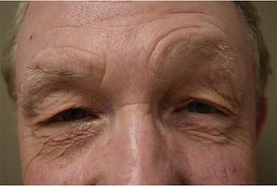 Eyelid Surgery Before & After Gallery - Patient 354416 - Image 1