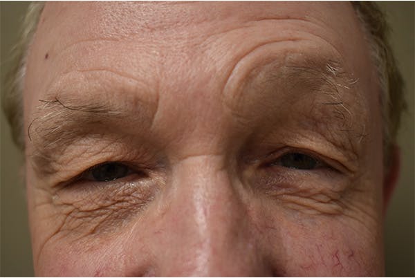 Eyelid Surgery Before & After Gallery - Patient 354416 - Image 1