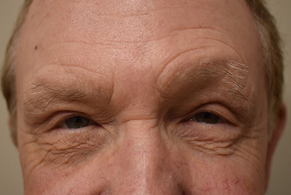 Eyelid Surgery Before & After Gallery - Patient 354416 - Image 2