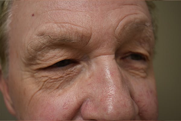 Eyelid Surgery Before & After Gallery - Patient 354416 - Image 3