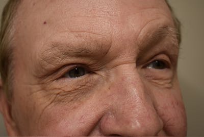 Eyelid Surgery Before & After Gallery - Patient 354416 - Image 4