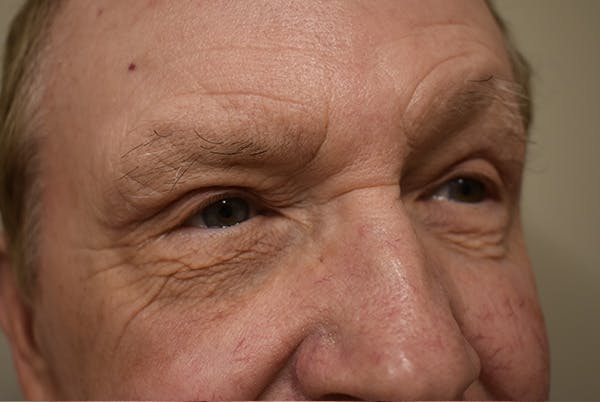Eyelid Surgery Before & After Gallery - Patient 354416 - Image 4