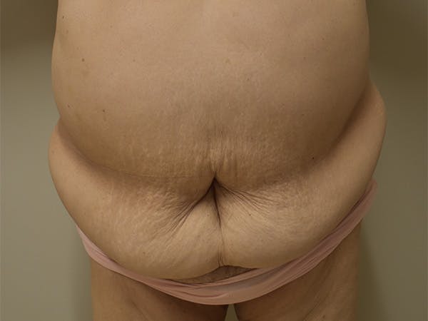 Tummy Tuck Before & After Gallery - Patient 105695 - Image 1