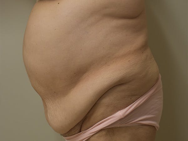 Tummy Tuck Before & After Gallery - Patient 105695 - Image 3