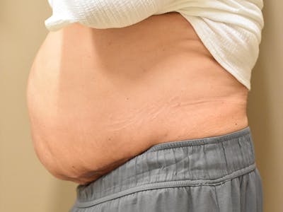 Tummy Tuck Before & After Gallery - Patient 105695 - Image 4